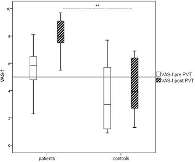 Fatigue and Cognitive Fatigability in Mild Traumatic Brain Injury are Correlated with Altered Neural Activity during Vigilance Test Performance